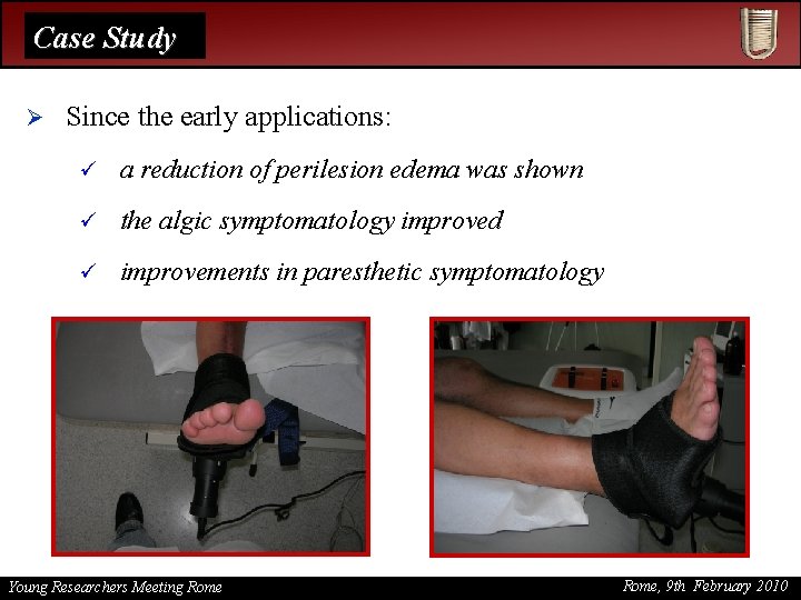 Case Study Ø Since the early applications: ü a reduction of perilesion edema was