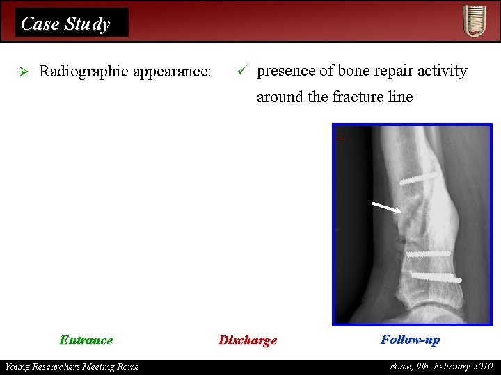 Case Study Ø Radiographic appearance: ü presence of bone repair activity around the fracture