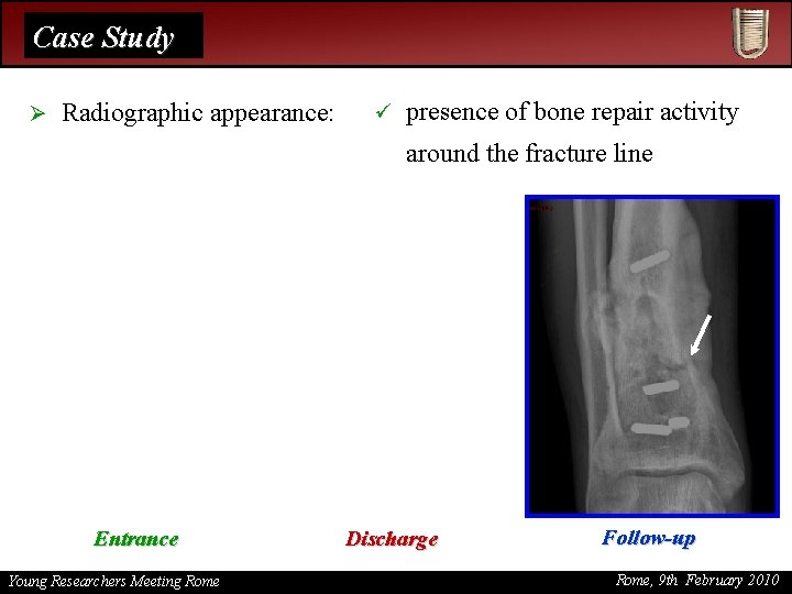 Case Study Ø Radiographic appearance: ü presence of bone repair activity around the fracture