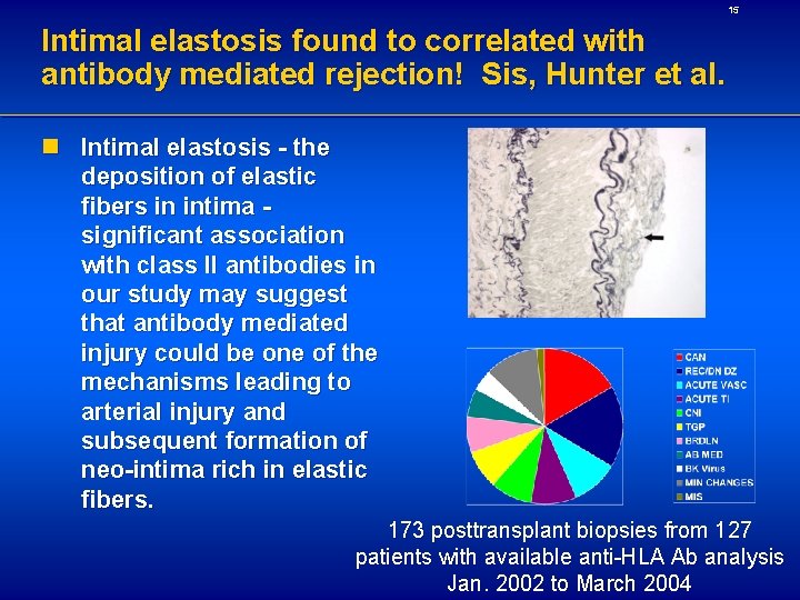 15 Intimal elastosis found to correlated with antibody mediated rejection! Sis, Hunter et al.