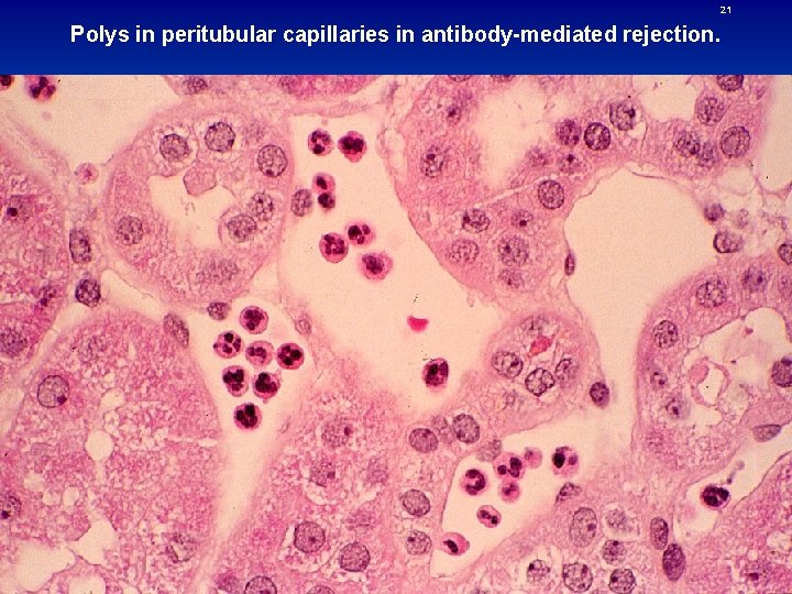 21 Polys in peritubular capillaries in antibody-mediated rejection. 