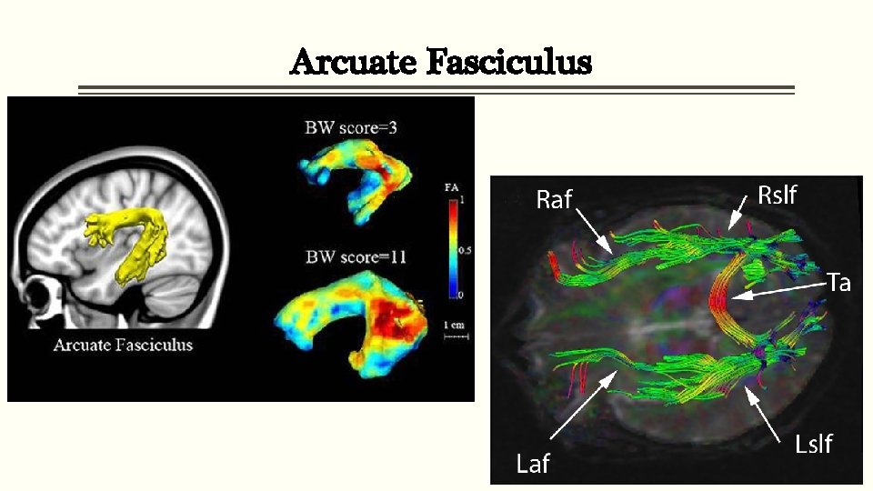 Arcuate Fasciculus 
