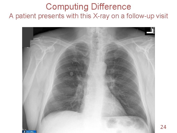 Computing Difference A patient presents with this X-ray on a follow-up visit 24 