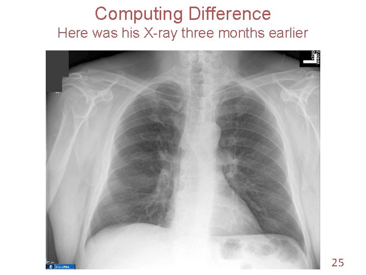 Computing Difference Here was his X-ray three months earlier 25 
