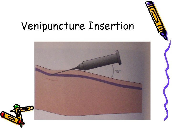 Venipuncture Insertion 