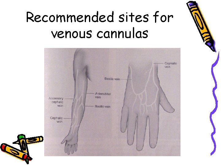 Recommended sites for venous cannulas 