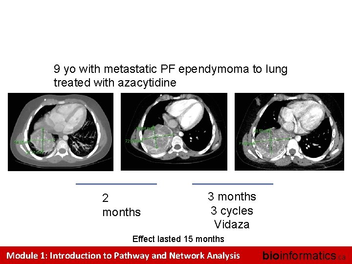 Treatment of Metastatic PF ependymoma with Vidaza 9 yo with metastatic PF ependymoma to