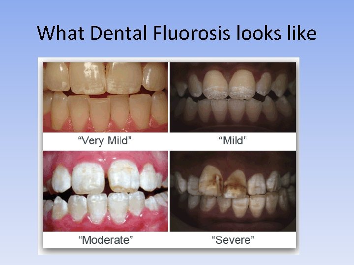 What Dental Fluorosis looks like 