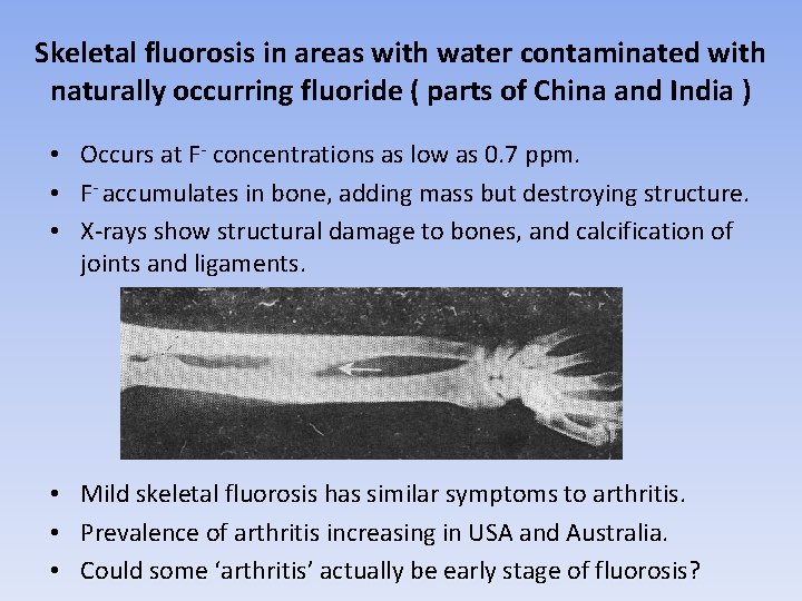 Skeletal fluorosis in areas with water contaminated with naturally occurring fluoride ( parts of