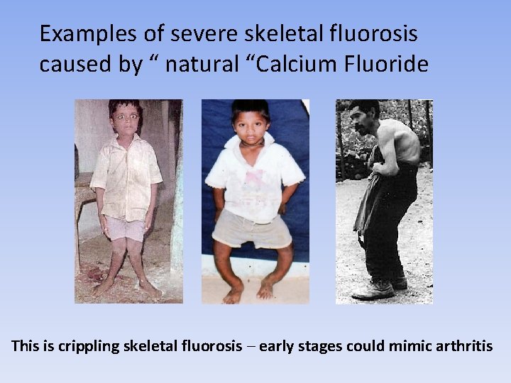 Examples of severe skeletal fluorosis caused by “ natural “Calcium Fluoride This is crippling