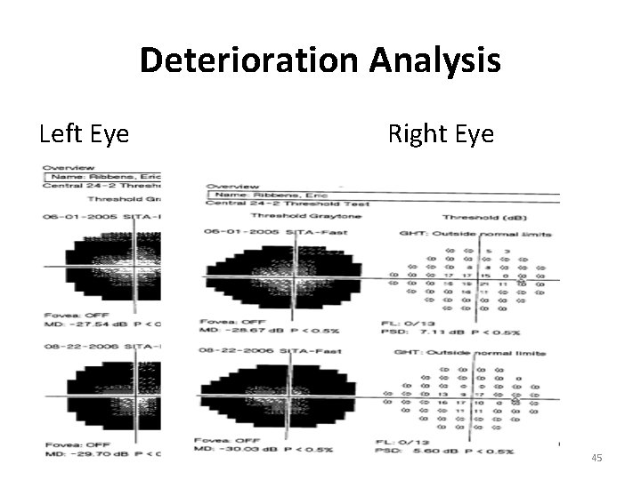 Deterioration Analysis Left Eye Right Eye 45 