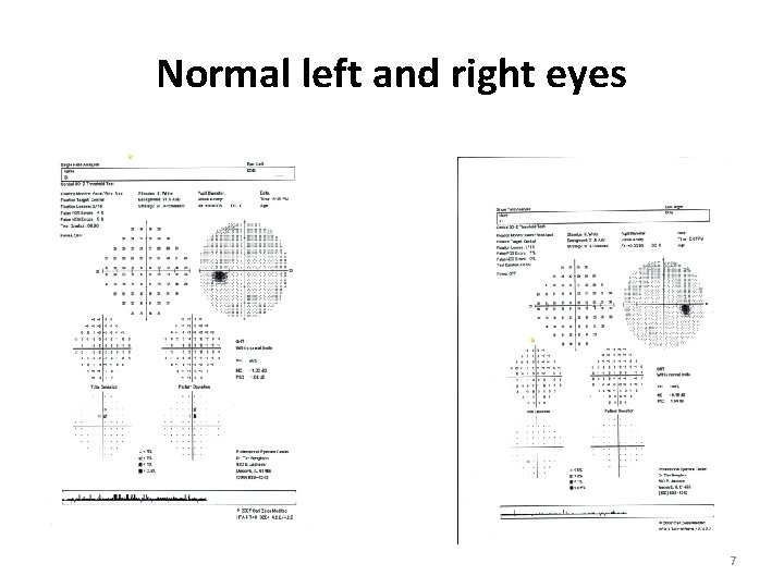 Normal left and right eyes 7 