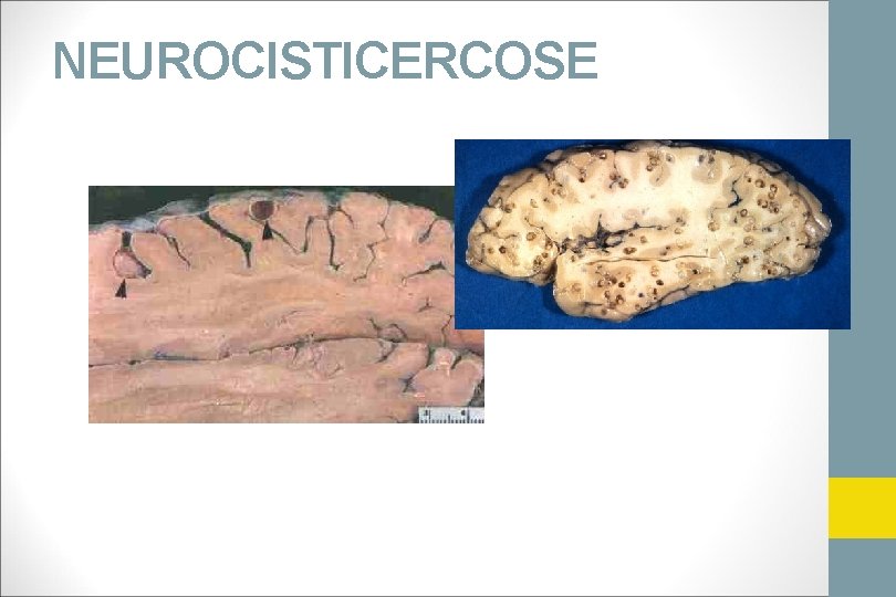 NEUROCISTICERCOSE 