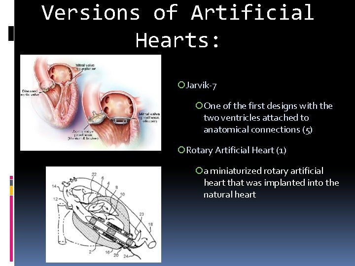 Versions of Artificial Hearts: ¡Jarvik-7 ¡One of the first designs with the two ventricles