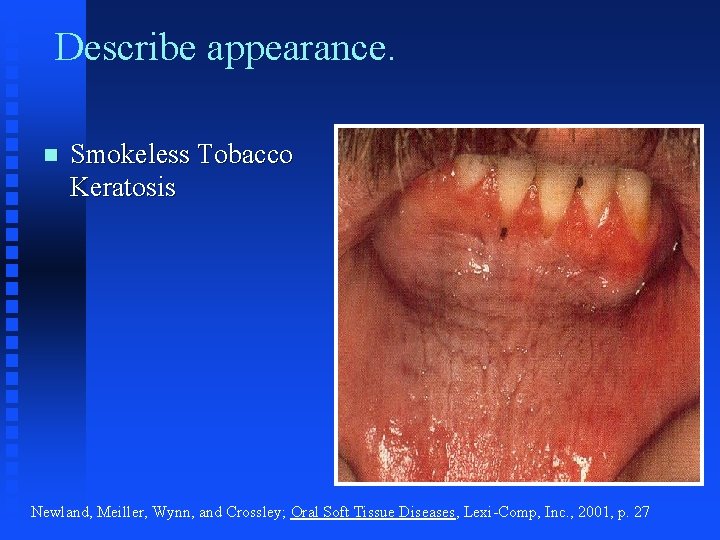 Describe appearance. n Smokeless Tobacco Keratosis Newland, Meiller, Wynn, and Crossley; Oral Soft Tissue Describe appearance. n Smokeless Tobacco Keratosis Newland, Meiller, Wynn, and Crossley; Oral Soft Tissue