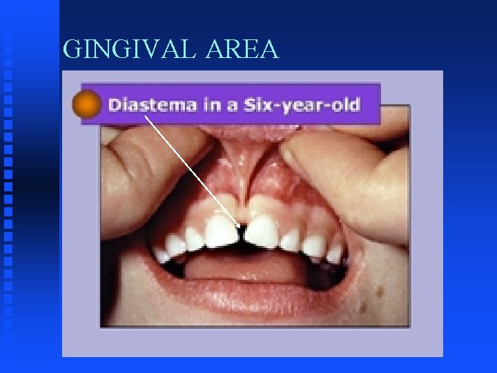 GINGIVAL AREA GINGIVAL AREA