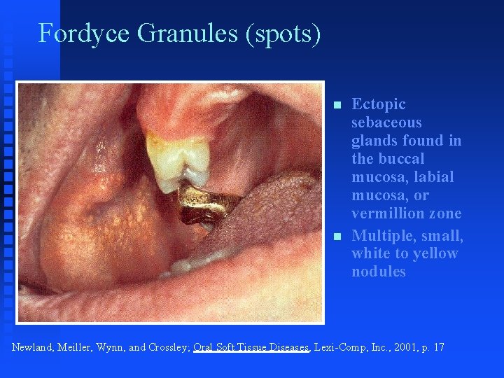 Fordyce Granules (spots) n n Ectopic sebaceous glands found in the buccal mucosa, labial