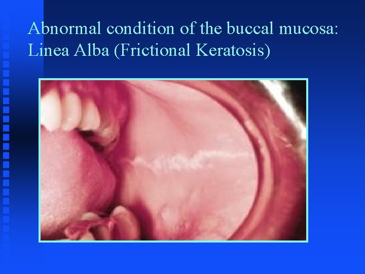 Abnormal condition of the buccal mucosa: Linea Alba (Frictional Keratosis) Abnormal condition of the buccal mucosa: Linea Alba (Frictional Keratosis)