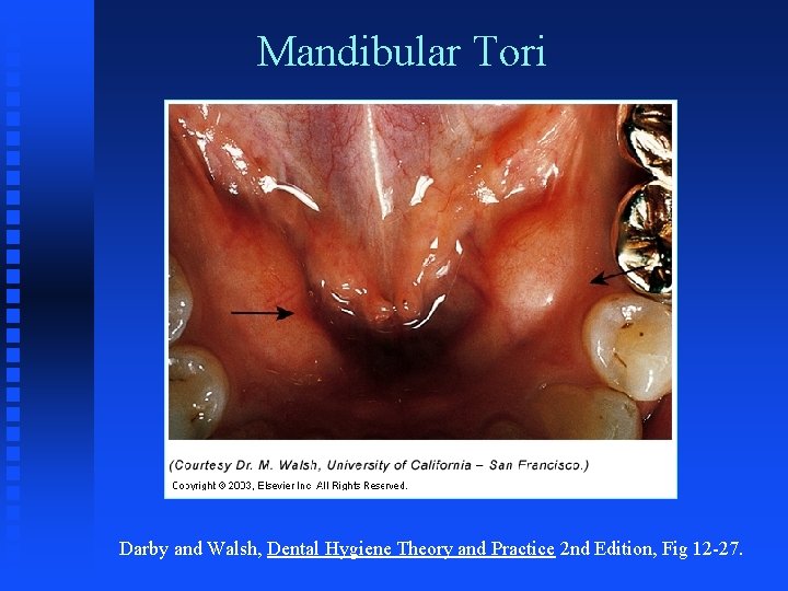 Mandibular Tori Darby and Walsh, Dental Hygiene Theory and Practice 2 nd Edition, Fig