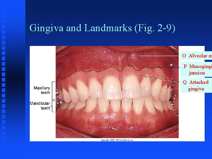 Gingiva and Landmarks (Fig. 2 -9) O Alveolar m P Mucogingi juncion Q Attached