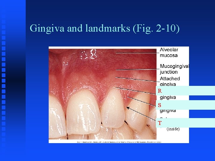 Gingiva and landmarks (Fig. 2 -10) R S T (inside) 