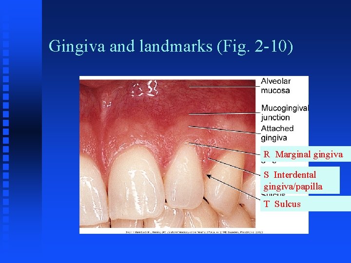 Gingiva and landmarks (Fig. 2 -10) R Marginal gingiva S Interdental gingiva/papilla T Sulcus