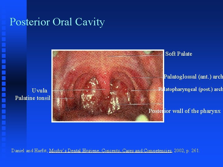 Posterior Oral Cavity Soft Palate Palatoglossal (ant. ) arch Uvula Palatine tonsil Palatopharyngeal (post.