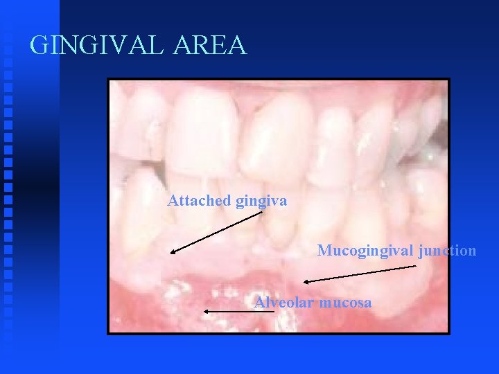 GINGIVAL AREA Attached gingiva Mucogingival junction Alveolar mucosa GINGIVAL AREA Attached gingiva Mucogingival junction Alveolar mucosa