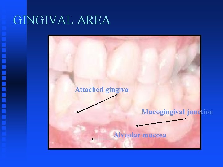 GINGIVAL AREA Attached gingiva Mucogingival junction Alveolar mucosa 