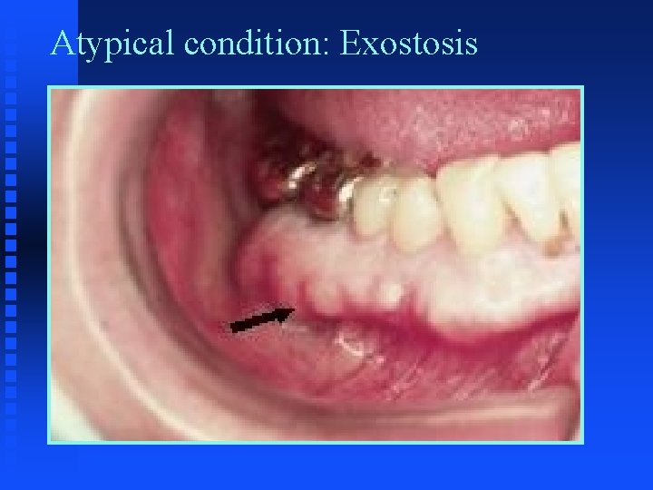 Atypical condition: Exostosis Atypical condition: Exostosis