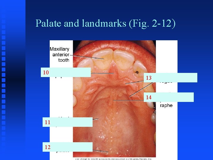 Palate and landmarks (Fig. 2 -12) 10 13 14 11 12 