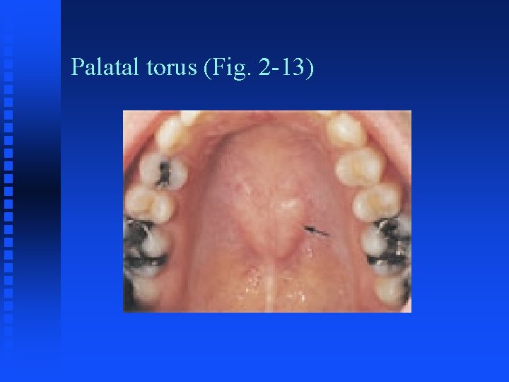 Palatal torus (Fig. 2 -13) Palatal torus (Fig. 2 -13)