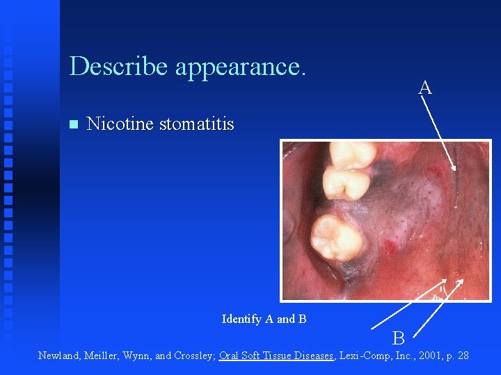 Describe appearance. n A Nicotine stomatitis Identify A and B B Newland, Meiller, Wynn,