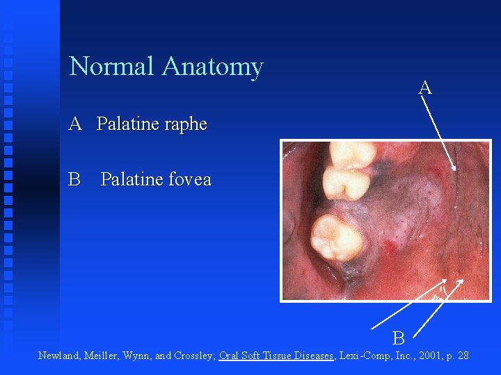 Normal Anatomy A A Palatine raphe B Palatine fovea B Newland, Meiller, Wynn, and