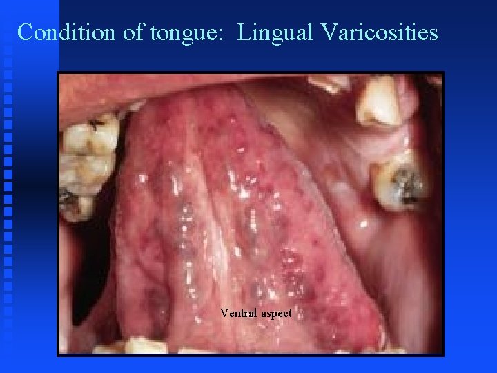 Condition of tongue: Lingual Varicosities Circumvallate papilla n Filiform papilla n Foliate papilla n