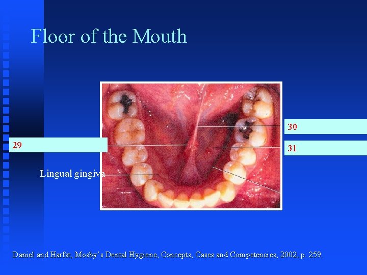 Floor of the Mouth 30 29 31 Lingual gingiva Daniel and Harfst, Mosby’s Dental