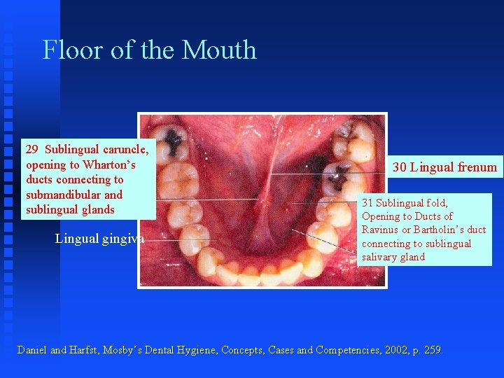 Floor of the Mouth 29 Sublingual caruncle, opening to Wharton’s ducts connecting to submandibular