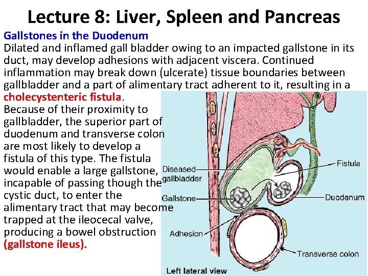 Lecture 8: Liver, Spleen and Pancreas Gallstones in the Duodenum Dilated and inflamed gall