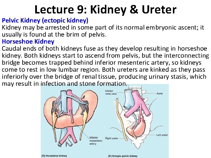 Lecture 9: Kidney & Ureter Pelvic Kidney (ectopic kidney) Kidney may be arrested in