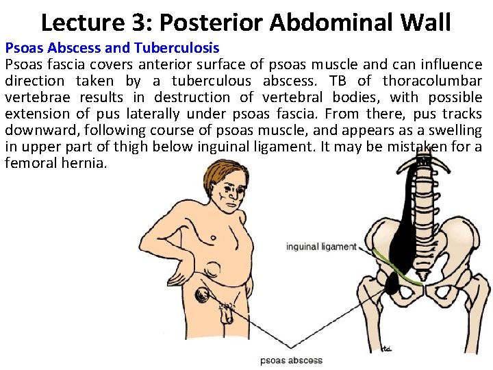 Lecture 3: Posterior Abdominal Wall Psoas Abscess and Tuberculosis Psoas fascia covers anterior surface