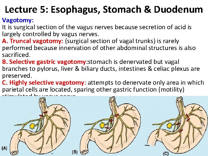 Lecture 5: Esophagus, Stomach & Duodenum Vagotomy: It is surgical section of the vagus