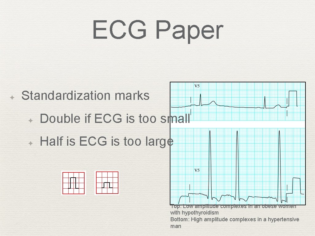 ECG Paper ✦ Standardization marks ✦ Double if ECG is too small ✦ Half