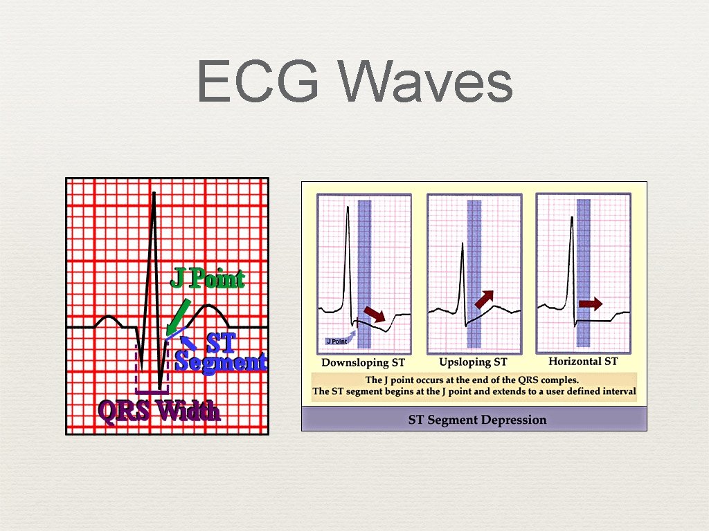 ECG Waves 