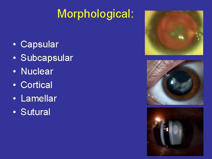 Morphological: • • • Capsular Subcapsular Nuclear Cortical Lamellar Sutural 