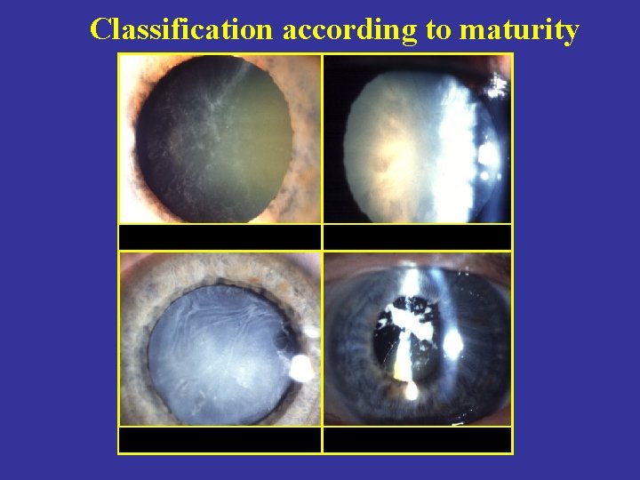 Classification according to maturity Immature Hypermature Morgagnian 