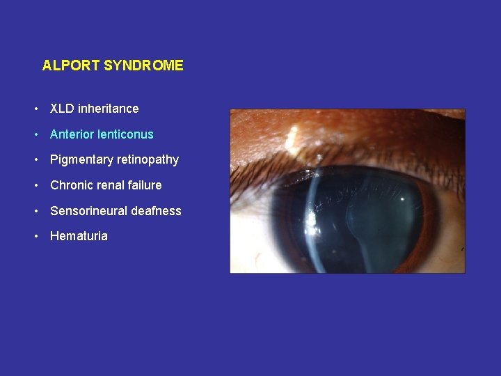 ALPORT SYNDROME • XLD inheritance • Anterior lenticonus • Pigmentary retinopathy • Chronic renal