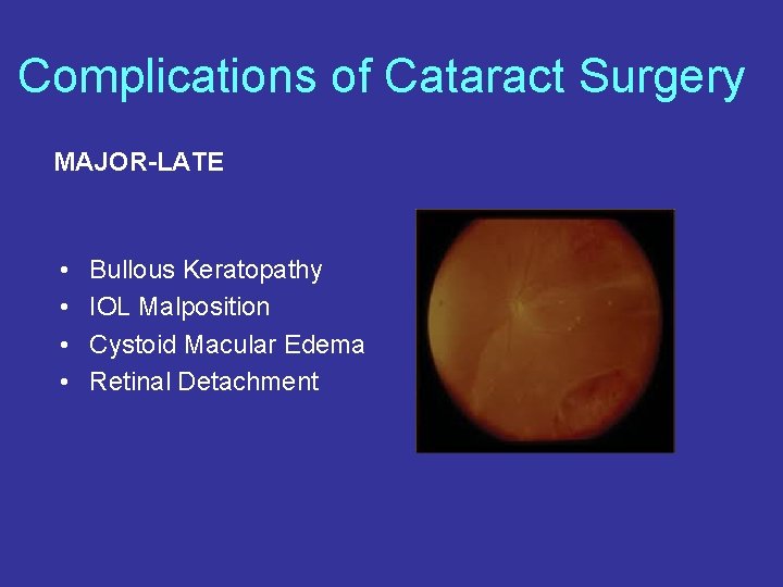 Complications of Cataract Surgery MAJOR-LATE • • Bullous Keratopathy IOL Malposition Cystoid Macular Edema