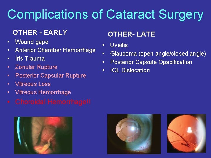 Complications of Cataract Surgery OTHER - EARLY • • Wound gape Anterior Chamber Hemorrhage