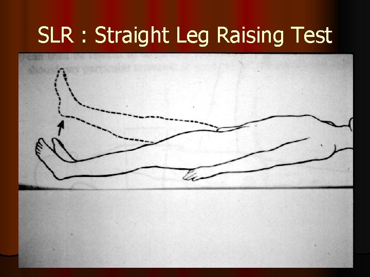 SLR : Straight Leg Raising Test 