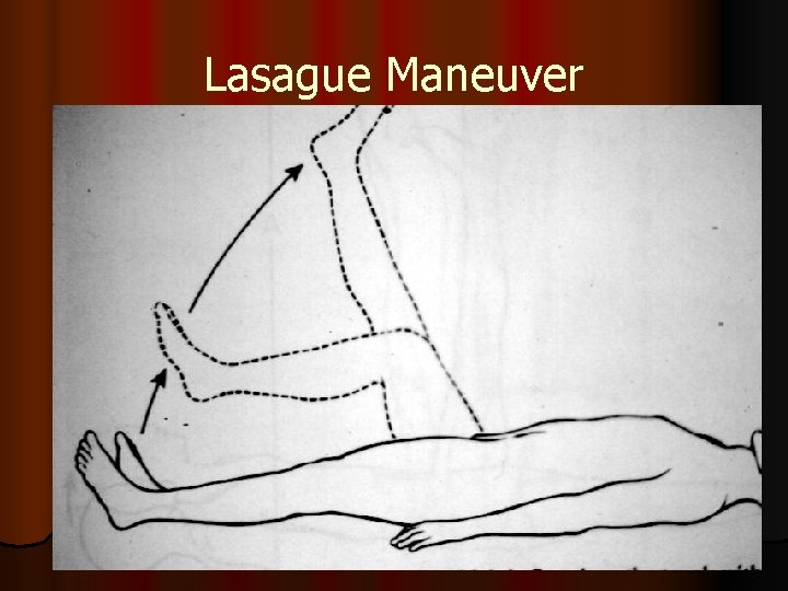 Lasague Maneuver 